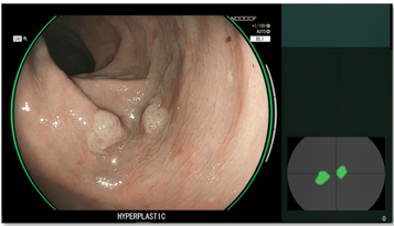 大腸ポリープ鑑別支援モード画像