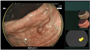 大腸ポリープ鑑別支援モード画像